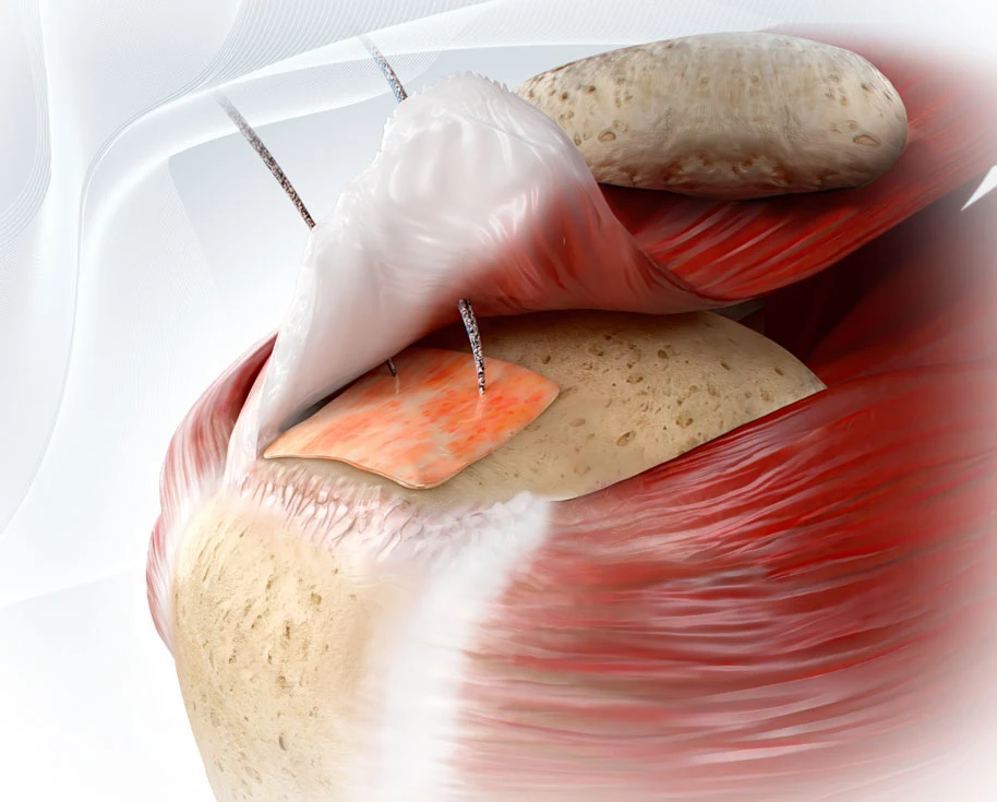 ROTIUM® Bioresorbable Wick for Rotator Cuff Repairs