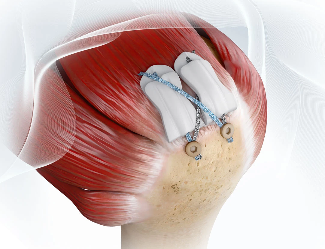 BioCharge® Autobiologic Matrix for Rotator Cuff Repair