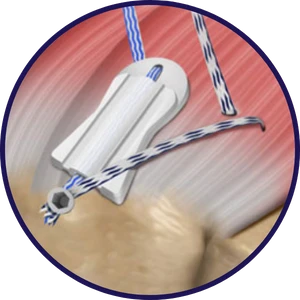 BioCharge® TECHNIQUE Step 2: Shuttle BioCharge® down cannula, retrieve additional sutures, and place lateral anchor.