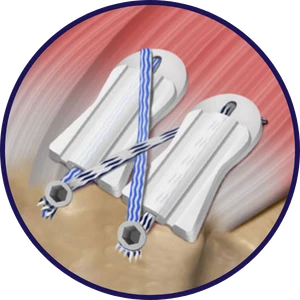 BioCharge® TECHNIQUE Step 3: Retrieve suture for 2nd BioCharge® and repeat steps 2-3 for 2nd lateral row anchor.
