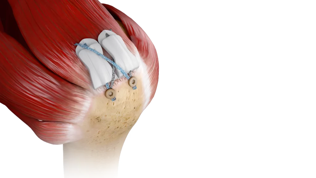 BioCharge® bioresorbable autobiologic matrix shown on Anatomy for rotator cuff repair