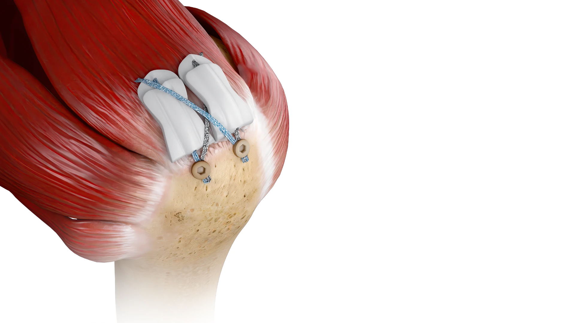 BioCharge® bioresorbable autobiologic matrix shown on Anatomy for rotator cuff repair