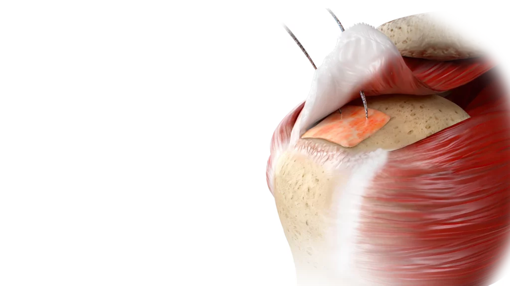 ROTIUM® Bioresorbable Wick for Rotator Cuff Repairs