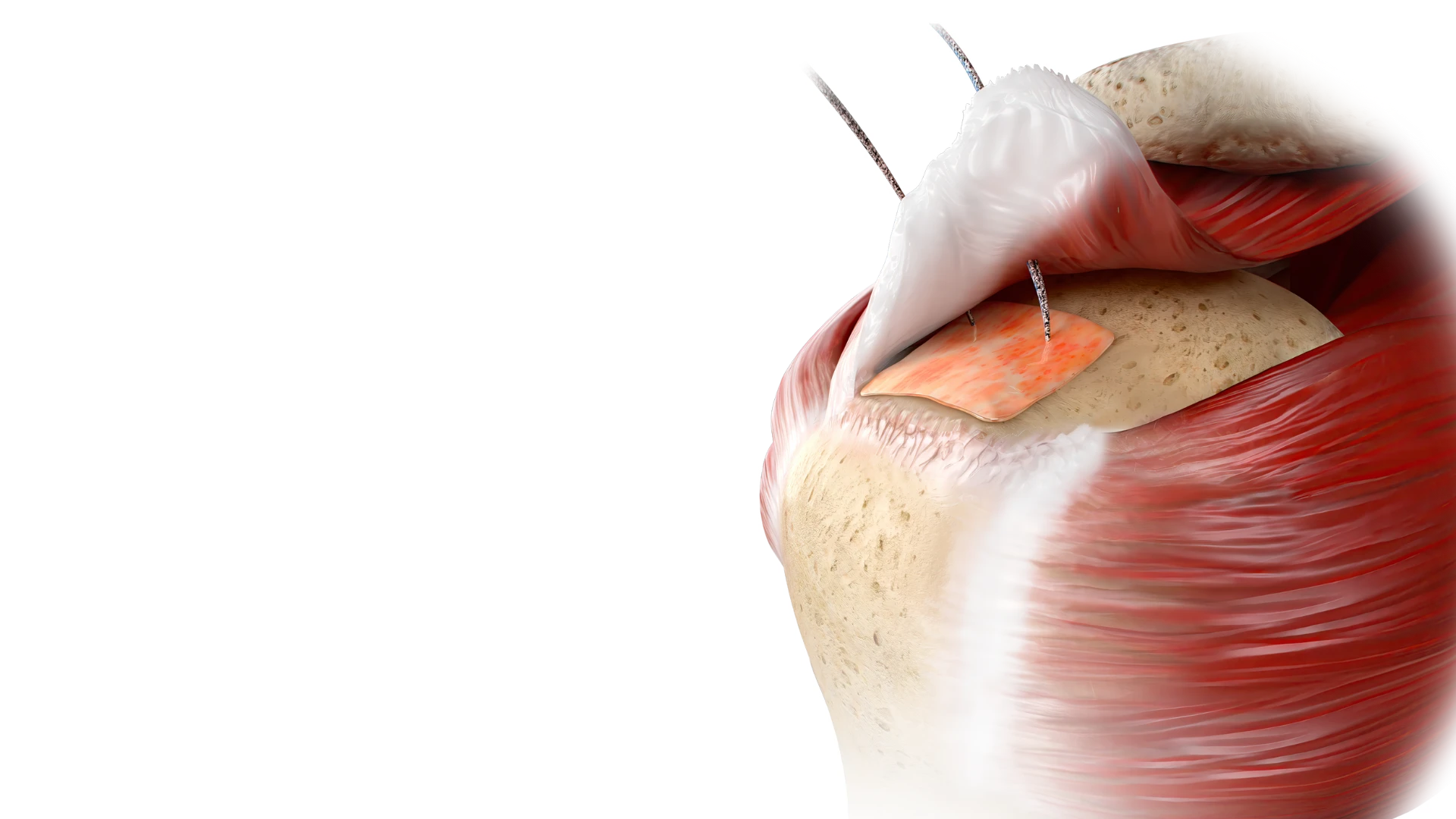 ROTIUM® Bioresorbable Wick for Rotator Cuff Repairs