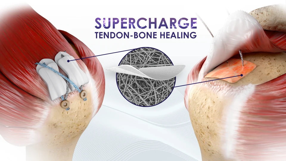 Supercharge Tendon-Bone Healing with the Rotium and BioCharge