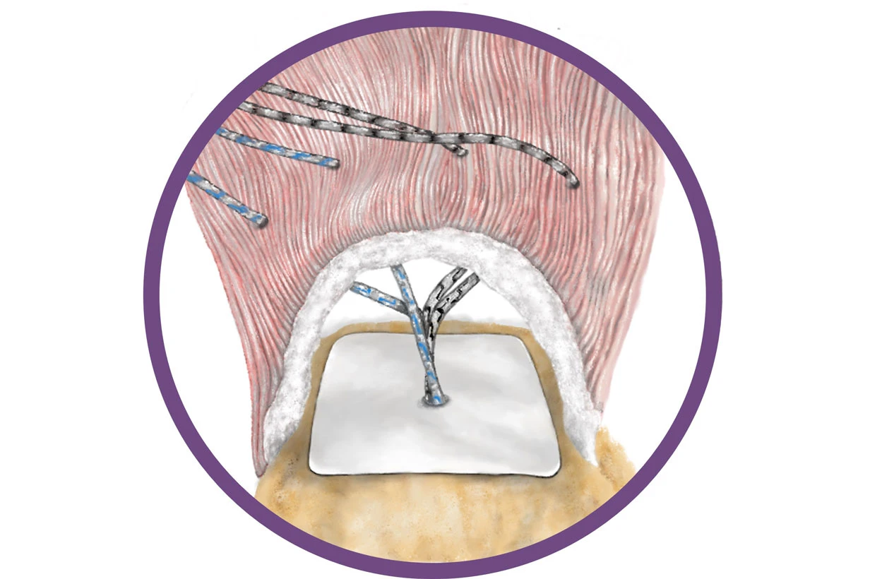 Rotator Cuff Repair Augmented With Interpositional Nanofiber Scaffold