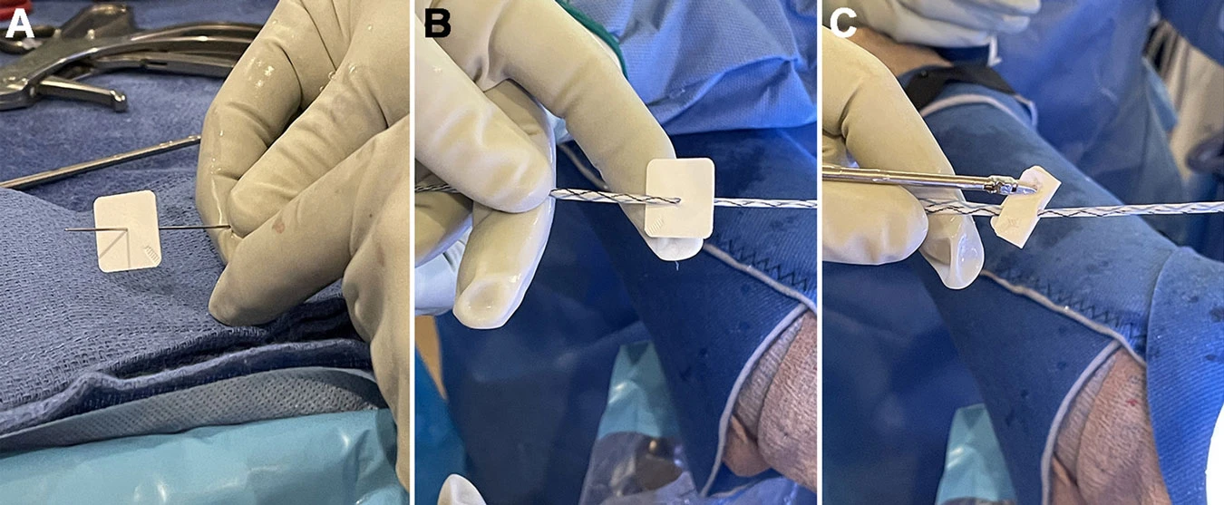 Use of a Nanofiber Resorbable Scaffold During Rotator Cuff Repair: Surgical Technique and Results After Repair of Small- to Medium-Sized Tears