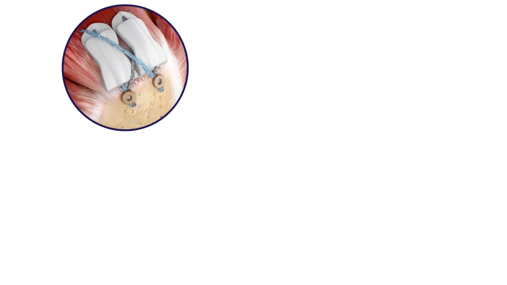 BioCharge® Autobiologic Matrix rotator cuff healing image bubble