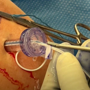 ROTIUM® Surgical Technique Videos Thumbnail