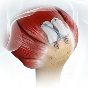 BioCharge® Brochure Thumbnail
