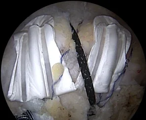 BioCharge® Surgical Technique Video Thumbnail