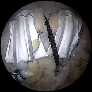 BioCharge® Surgical Technique Video Thumbnail