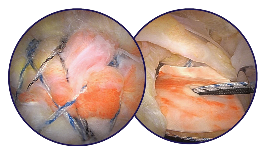 Arthroscopic images courtesy of Dr. Jacob Kirsch