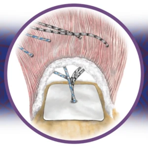 ROTIUM® Surgical Technique Guide Thumbnail