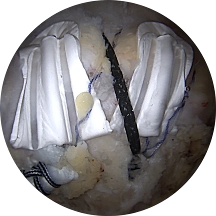 Arthroscopic Image of BioCharge courtesy of Dr. Dragomir Mijic