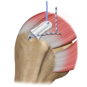 BioCharge® TECHNIQUE Step 2: Shuttle BioCharge® down cannula, retrieve additional sutures, and place lateral anchor.