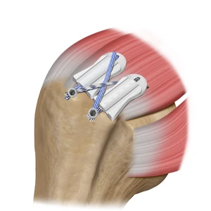 BioCharge® TECHNIQUE Step 3: Retrieve suture for 2nd BioCharge® and repeat steps 2-3 for 2nd lateral row anchor.
