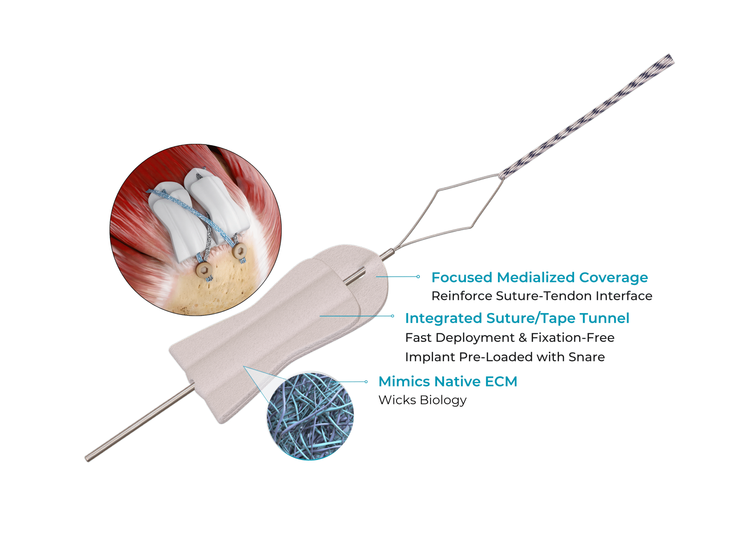 BioCharge® Bioresorbable Autobiologic Matrix Rotator Cuff Features
