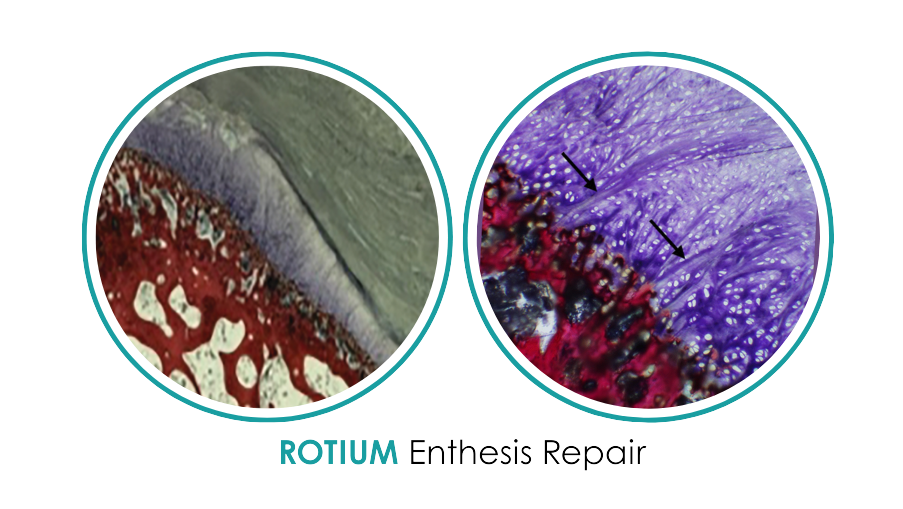Rotium Enthesis Repair