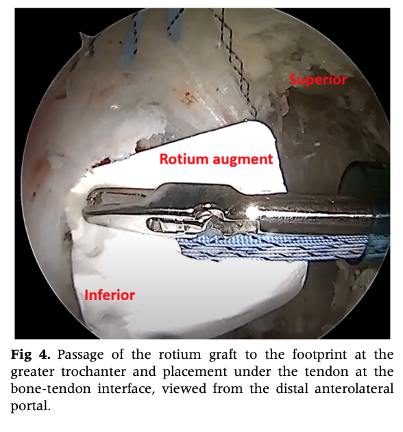 Passage of the rotium graft to the footprint at the
greater trochanter and placement under the tendon at the
bone-tendon interface, viewed from the distal anterolateral
portal. Arthroscopy Techniques, Vol 14, No 4 (April), 2025: 103312 e1