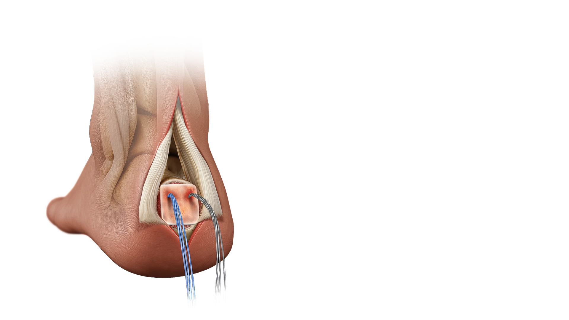 ROTIUM® Bioresorbable Wick for Achilles Tendon Foot Repairs