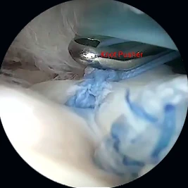 Bioaugmentation of Rotator Cuff Repair With an Interpositional Nanofiber Scaffold