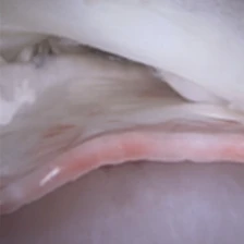 Biomechanical Enhancement in Rotator Cuff Repairs: The Impact of Innovative Nanofiber Technology