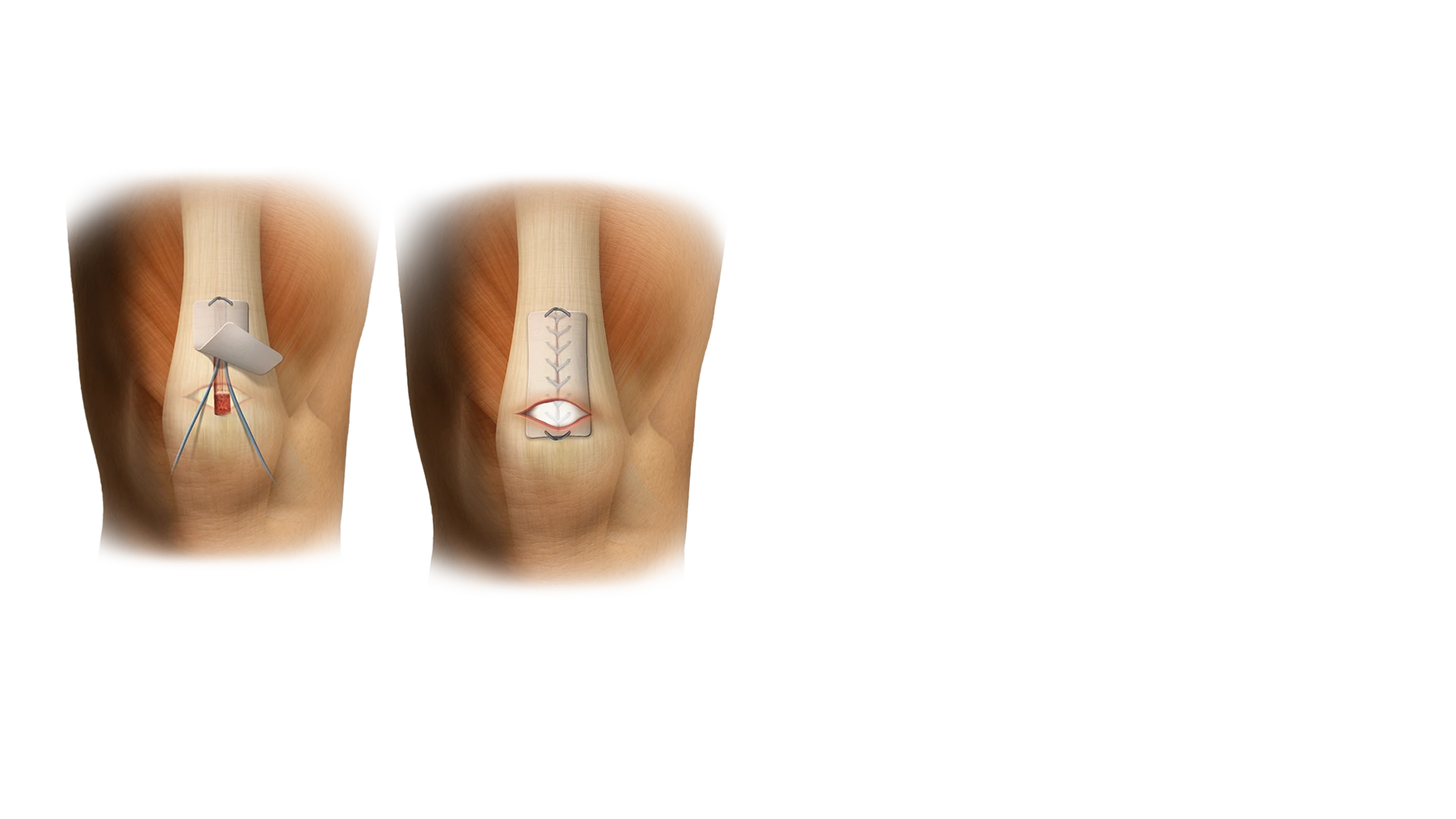 ROTIUM® Bioresorbable Wick for Knee Tendon Repairs