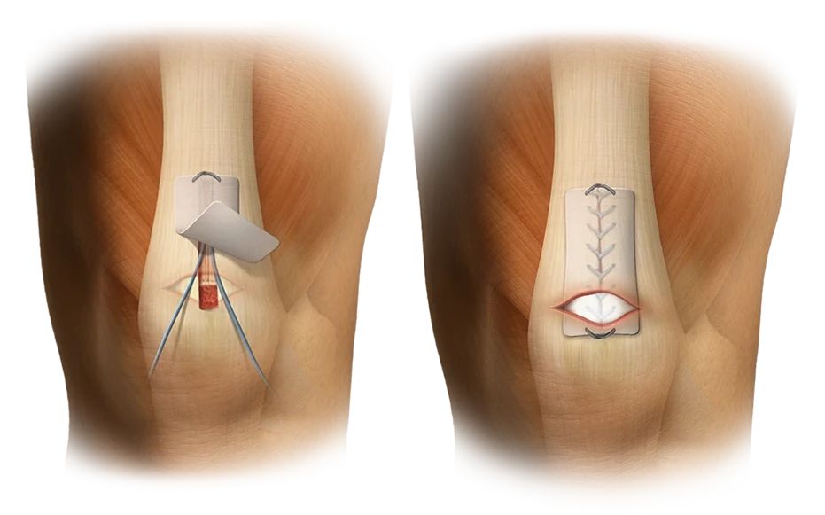 ROTIUM® Bioresorbable Wick for Knee Tendon Repairs