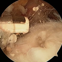 Rotator Cuff Repair Augmented With Interpositional Nanofiber Scaffold