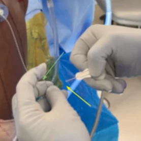 Rotator Cuff Repair Augmented With a Reinforced Bioabsorbable Autobiologic Matrix