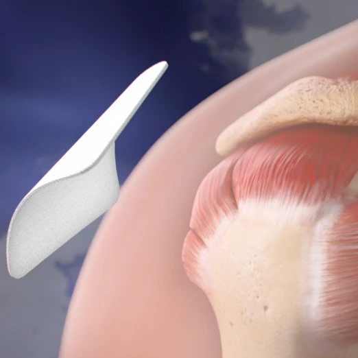 Short-Term Radiographic and Clinical Outcomes of Arthroscopic Rotator Cuff Repair with and without Augmentation with an Interpositional Nanofiber Scaffold