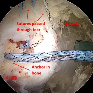 Surgical Technique: Using an Acellular Dermal Allograft and Bioresorbable Wick Scaffold During Endoscopic Gluteus Medius and Minimus Repair