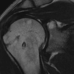 Use of a Nanofiber Resorbable Scaffold During Rotator Cuff Repair