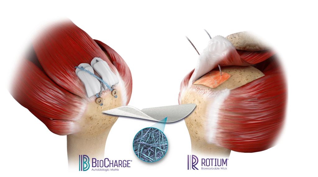image depicting BioCharge and ROTIUM implants for rotator cuff repair