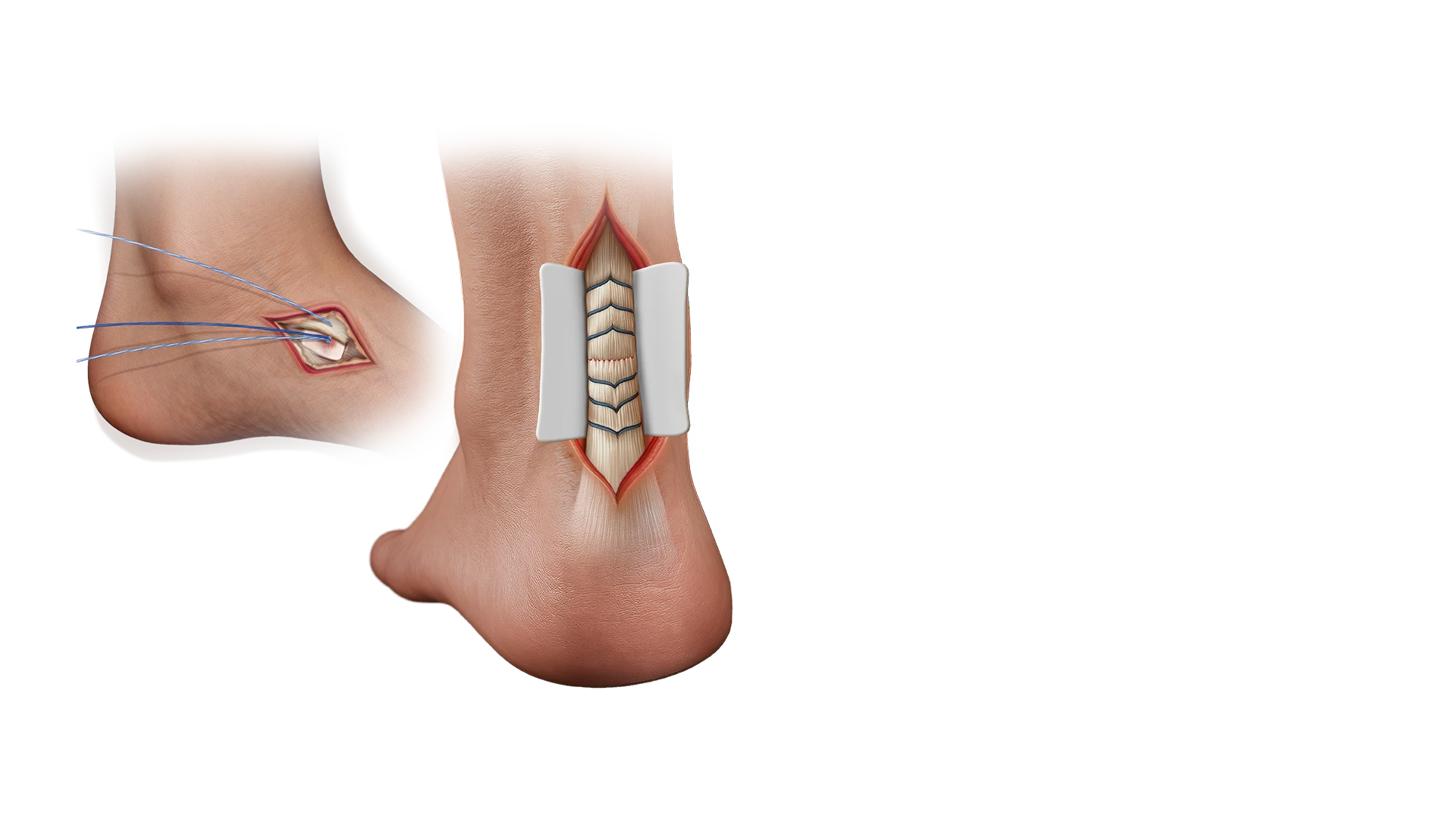 Kidner image and achilles Wrap image