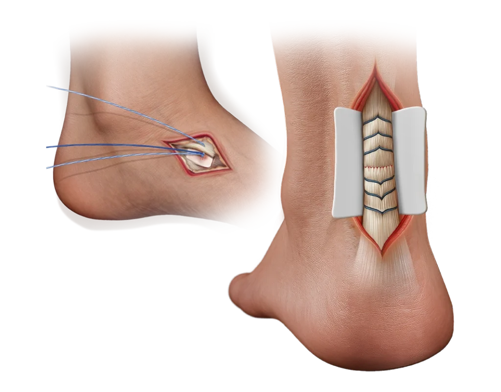 Kidner image and achilles Wrap image