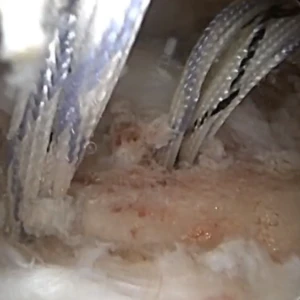 BioStack RCR - Dr. Kevin Cronin Video Thumbnail