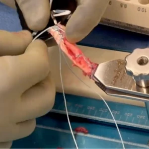 ROTIUM ACL - Dr. Elan Golan Video Thumnail