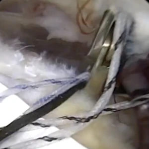 ROTIUM - Dr. Jacob Kirsch Video Thumbnail