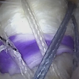 ROTIUM RCR - Dr. Kevin Cronin Video Thumnail