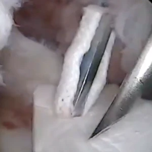 ROTIUM RCR - Dr. Vahid Entezari Video Thumbnail