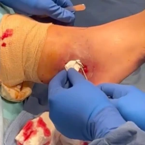 PHOENIX Foot & Ankle Video Thumb