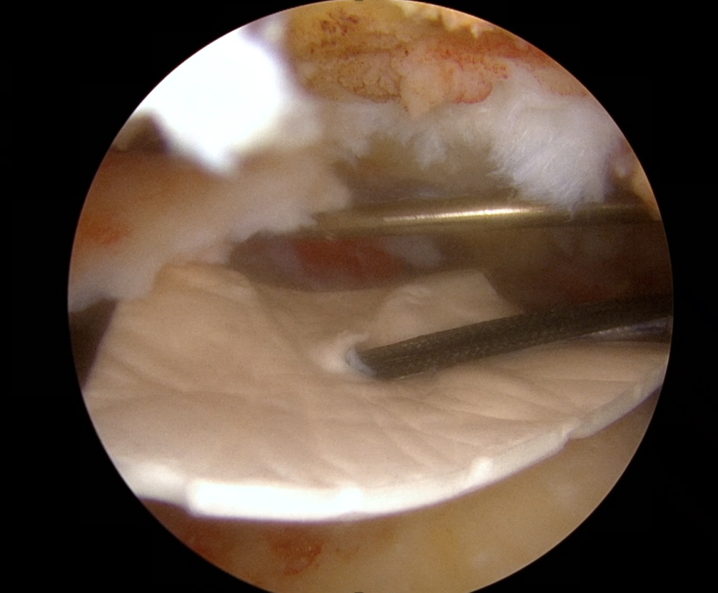 arthroscopic image of ROTIUM Bioresorbable Wick in a Rotator Cuff Repair