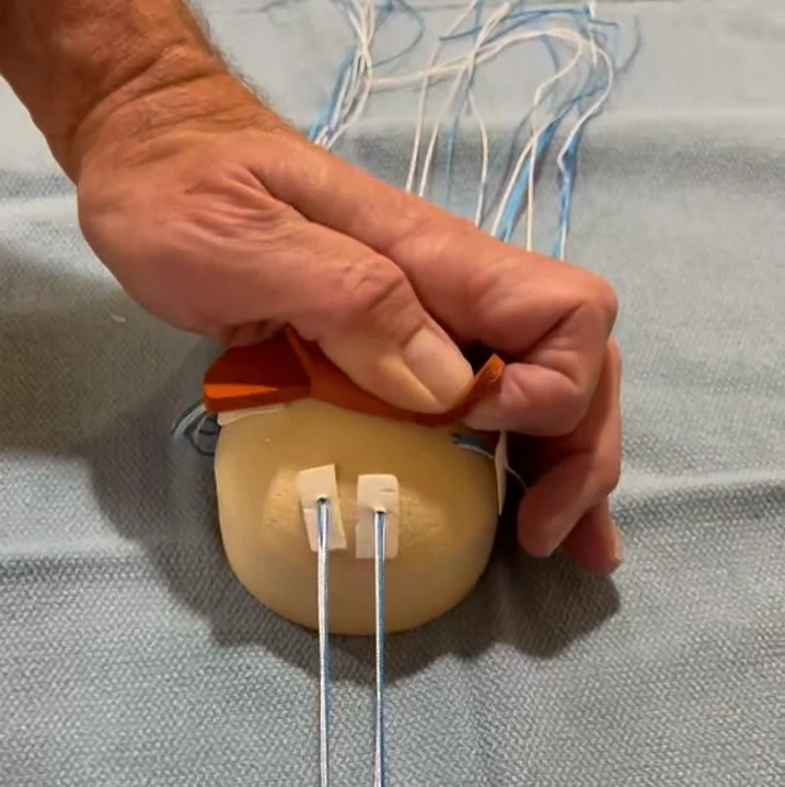 Suture hole placement options