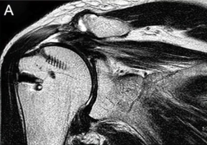 ARTHROSCOPIC SUBSCAPULARIS REPAIR WITH ROTIUM® BIORESORBABLE WICK Video