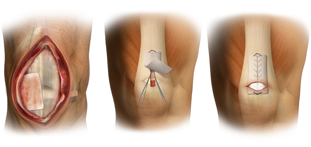 ROTIUM LoPro Knee applications
