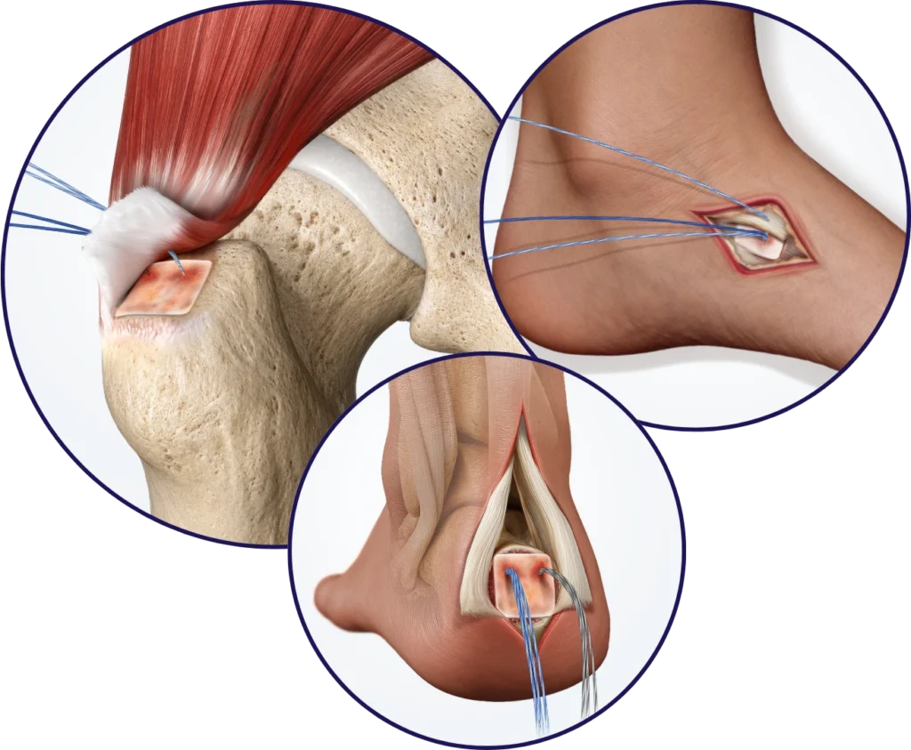 ROTIUM Across More Tendon-Bone Applications: Gluteus Medius Tendon Repair (open or arthroscopic)  FOOT & ANKLE APPLICATIONS  Achilles tendon reconstruction (Haglund’s deformity) Posterior tendon reattachment (Kidner procedure)